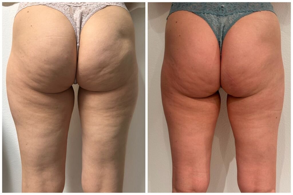 Before and after cellulite treatment - visibly smoother glutes and thighs at Love Your Body Studios