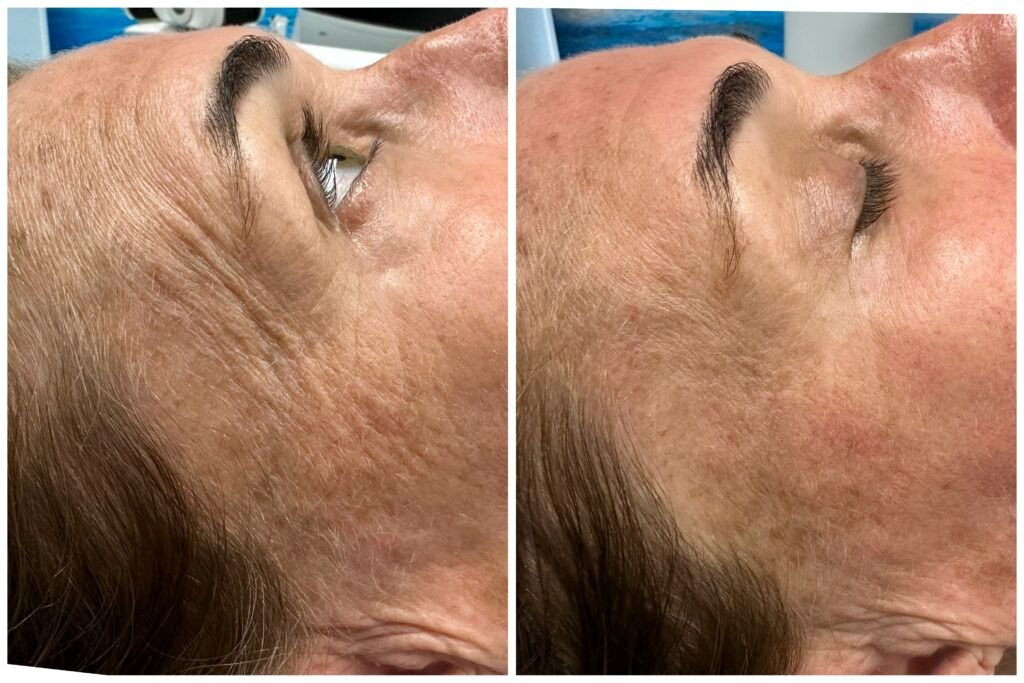 Before and after cellulite treatment - smoother back of thighs and glutes at Love Your Body Studios