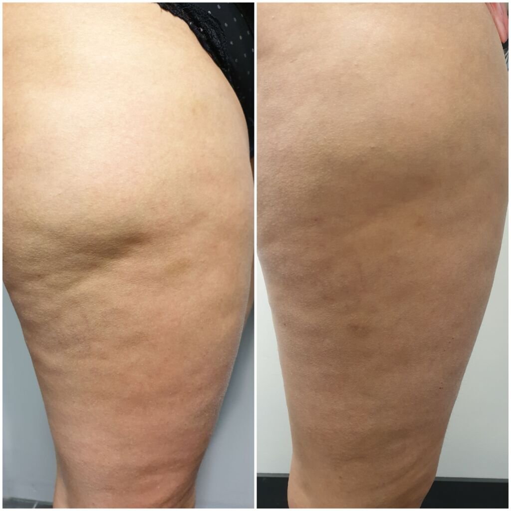 Before and after cellulite treatment - smoother outer thigh at Love Your Body Studios