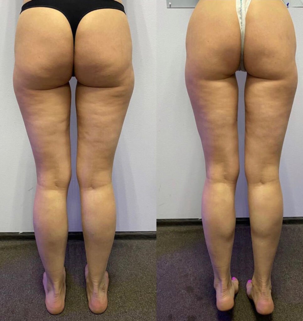 Before and after cellulite treatment - smoother back of legs at Love Your Body Studios