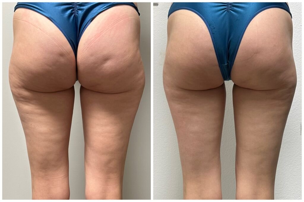 Before and after fine line reduction - smoother forehead skin at Love Your Body Studios
