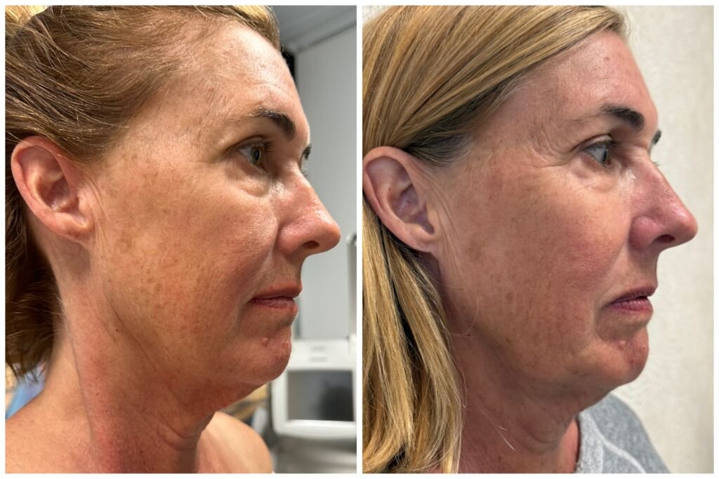 Before and after facial lifting - more defined jawline and neck at Love Your Body Studios