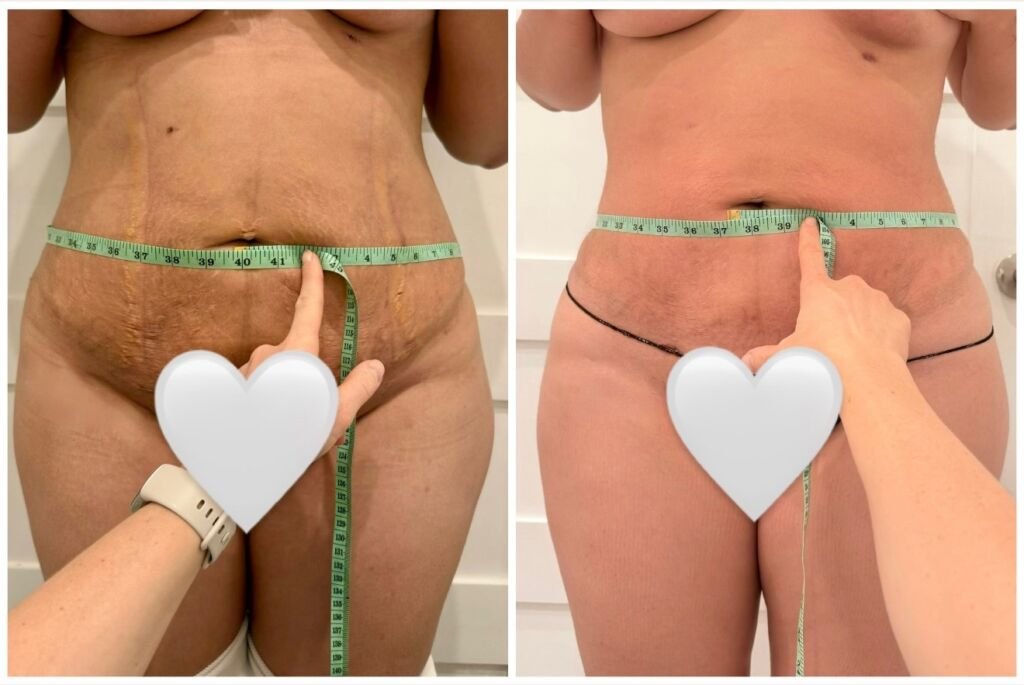 Before and after post-surgical recovery - abdomen healing and reduced swelling at Love Your Body Studios