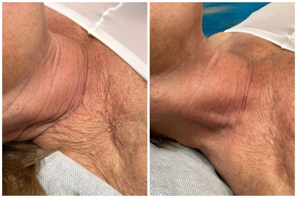 Before and after skin tightening - firmer neck and chest skin at Love Your Body Studios