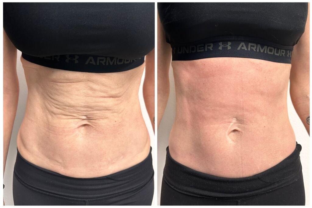 Before and after skin tightening - firmer abdomen skin at Love Your Body Studios