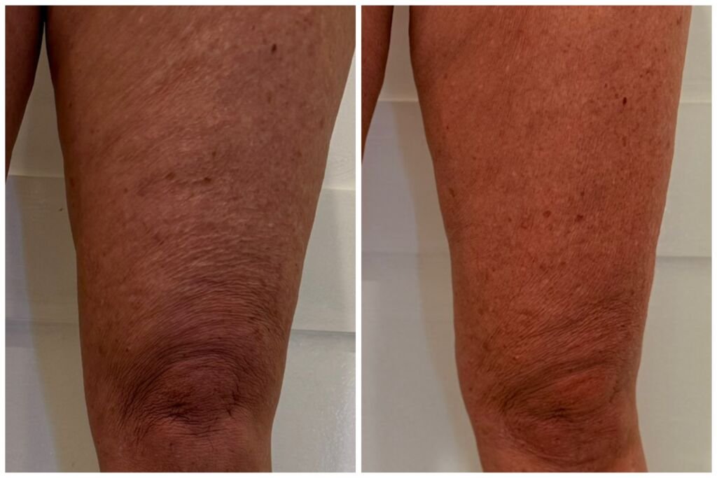 Before and after skin tightening - smoother skin above the knee at Love Your Body Studios