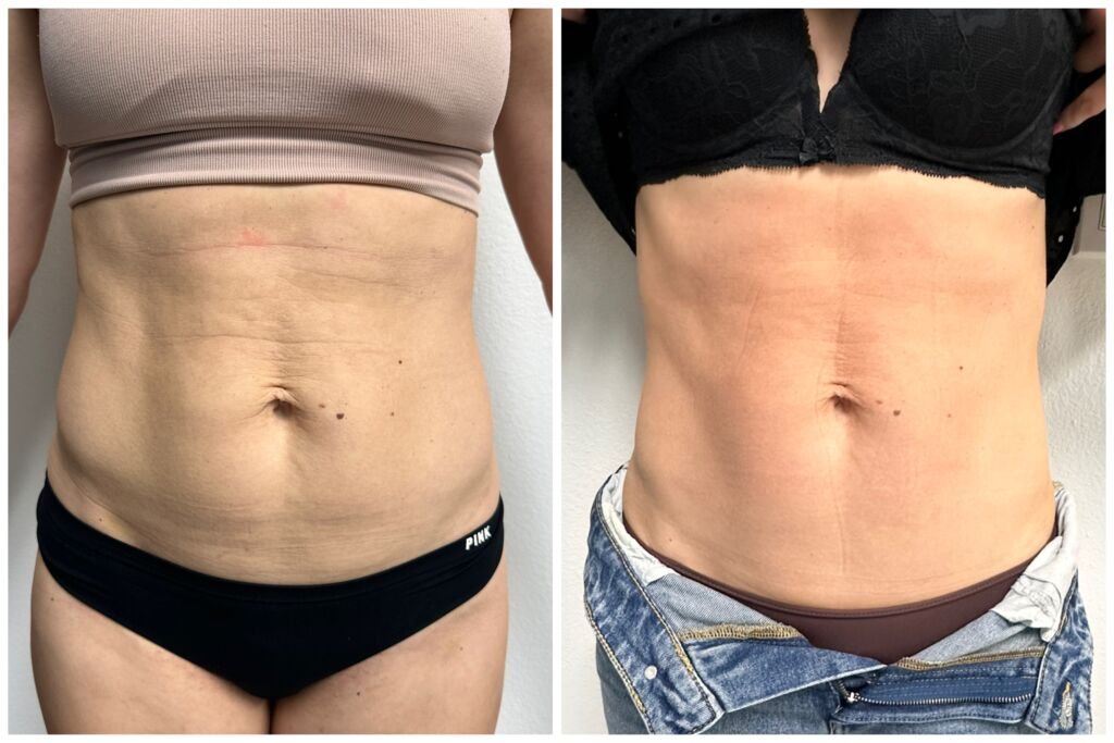 Before and after slimming - flatter abdomen at Love Your Body Studios