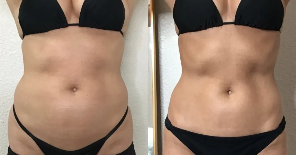 Cryoskin Slimming before and after results after 3 sessions - slimmer abdomen at Love Your Body Studios