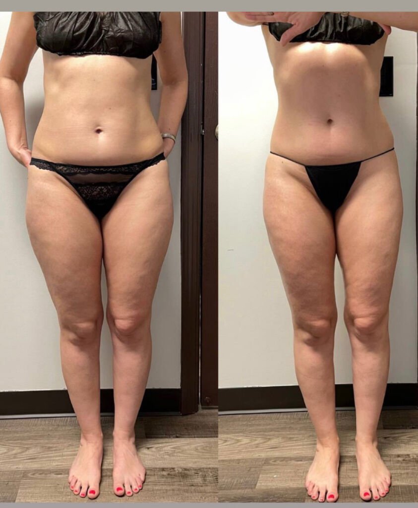 Endospheres before and after results after 10 sessions, age 37 - legs and body slimming at Love Your Body Studios