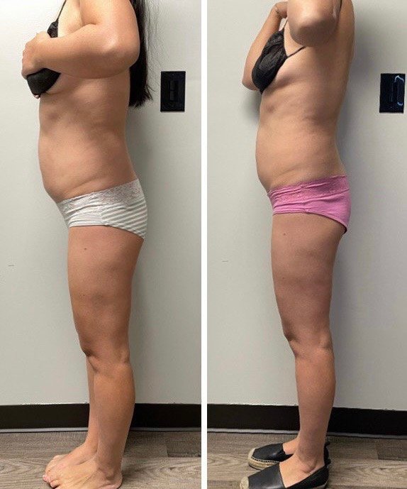 Endospheres before and after results after 10 sessions, age 40 - side profile slimming at Love Your Body Studios