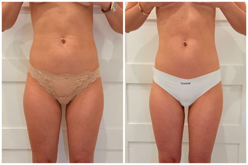 icoone before and after - slimmer waist and smoother abdomen at Love Your Body Studios