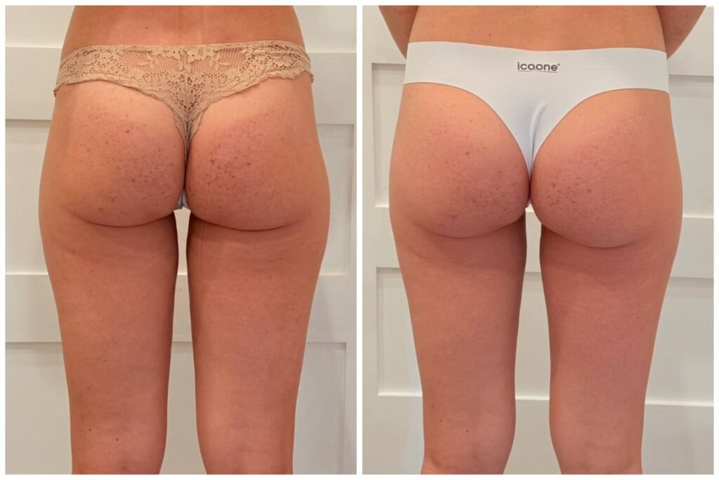 icoone before and after - smoother skin on glutes and thighs at Love Your Body Studios