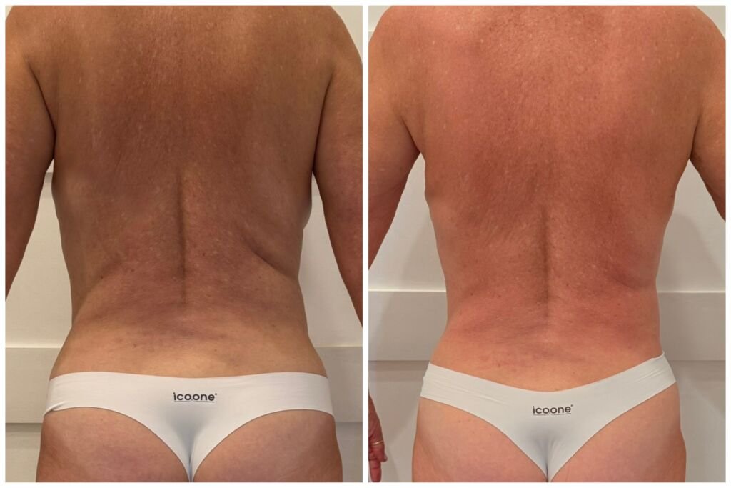 icoone before and after - smoother, firmer back skin at Love Your Body Studios