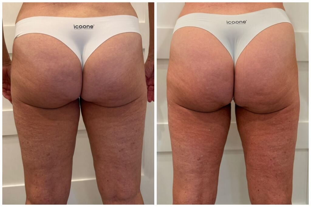 icoone before and after - lifted, smoother glutes at Love Your Body Studios